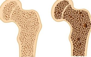 بهترین روش تشخیص پوکی استخوان/ دلایل ابتلا به بیماری